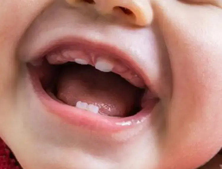 labial-frenum-500x400_jpg_350.webp