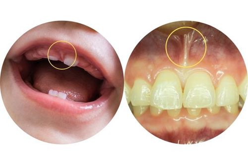 labial-frena-circles.jpg