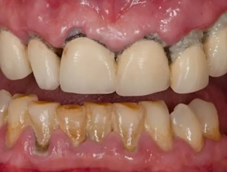 gum-disease-500-x-400_jpg_350.webp