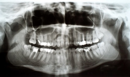 orthopantomogram.jpeg