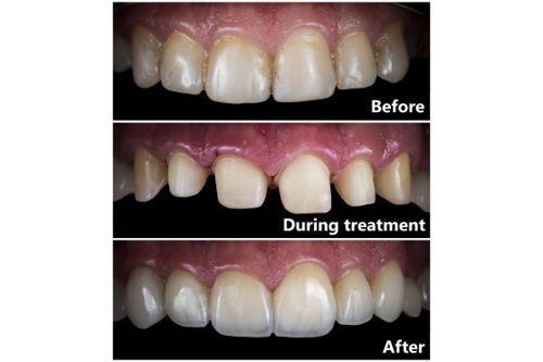 crown-steps-1.jpg