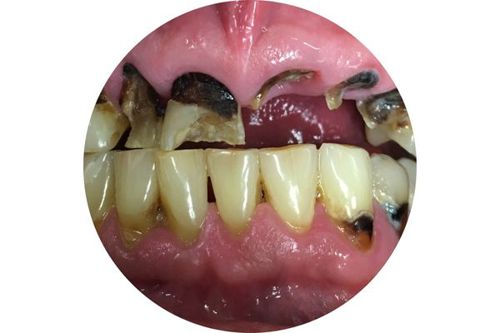 meth-mouth.jpg