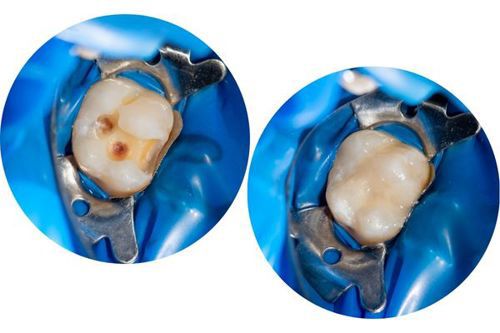 composite-resin-circles.jpg