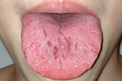 600fissured-tongue.jpg