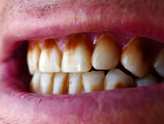 Teeth staining