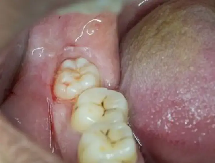 wisdom-teeth-500x400_jpg_350.webp