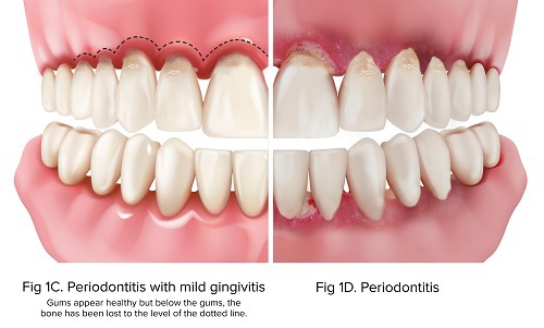 fig-1c_gingperi_1d-peri.jpg
