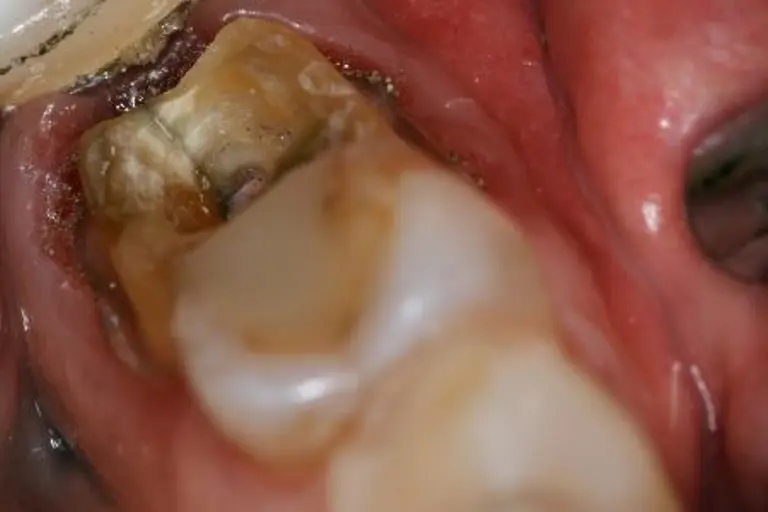 A molar tooth with a crack that starts at the top of the tooth and travels down the tooth's root.