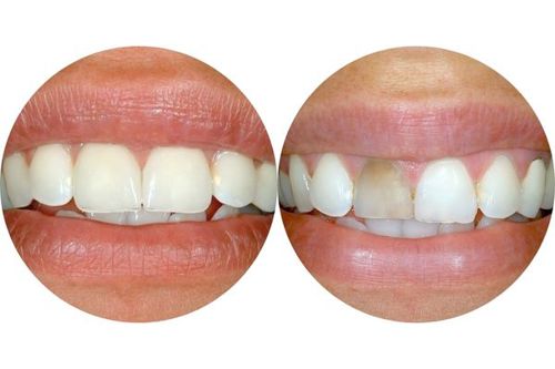 veneers-before-after-circles.jpg