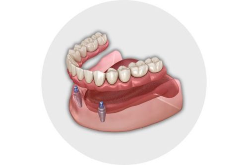 implant-dentures-circle.jpg