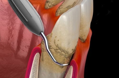 Non-surgical treatment of gum-disease using hand instruments