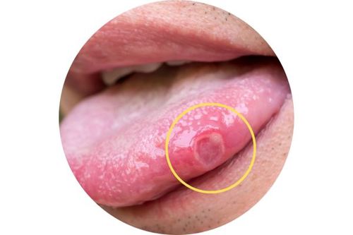 tongue-ulcer.jpg