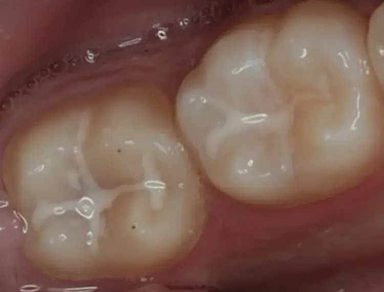 fissure-sealants-500x400_jpg_350.webp