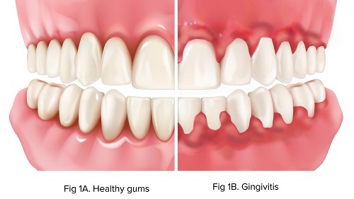 fig-1a-healthy_1b-ging.jpg