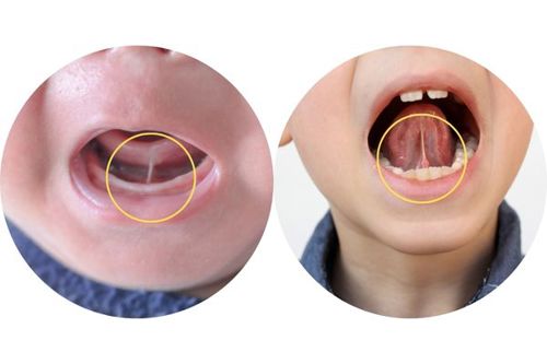 tongue-frena-circles.jpg (1)