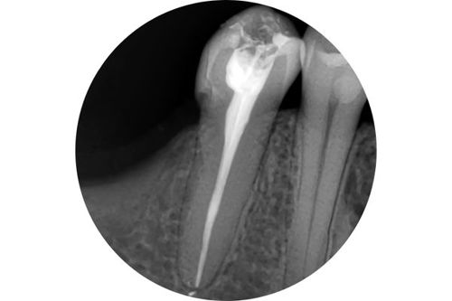 root-canal-treatment-xray-circle.jpg