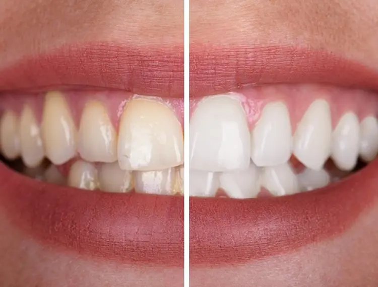 Teeth Whitening | Teeth.org.au