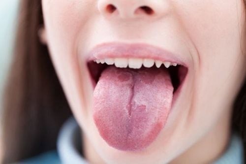 Geographic tongue female