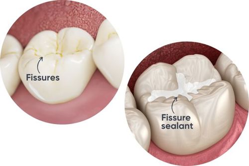 fissure-and-fissure-sealant.jpg