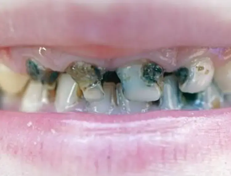 tooth-decay-500x400_jpg_350.webp