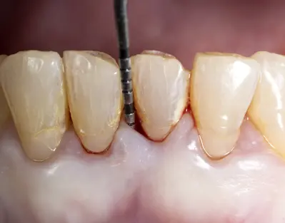 Gum disease - periodontitis