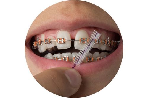 braces-interdental-cleaning-circle-1.jpg